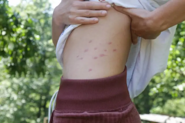 bed-bug-bites-featured-image